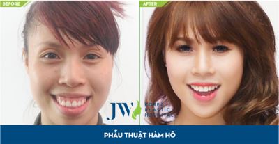 JW Hàn Quốc: Cơ hội phẫu thuật hàm hô móm không cần niềng răng miễn phí