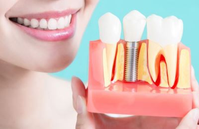 Trồng răng Implant giá trọn gói, sử dụng trọn đời